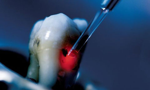 Laser Zahnarzt Anwendungsgebiete Bild 1